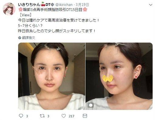 【整容後遺症】因ikiri再偷偷獨自去韓國整容,而這次需要削骨,作改善臉部輪廓的手術,因為這手術需要全身麻醉加切割顎骨,是一個較高風險的手術