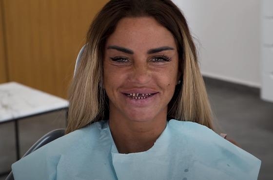 早前英國模特兒 Katie Price 更將自己弄牙貼後的牙齒情況騷給粉絲看，畫面令人嘩然！為了一排完美無瑕的牙齒，大家又願意付出多少？