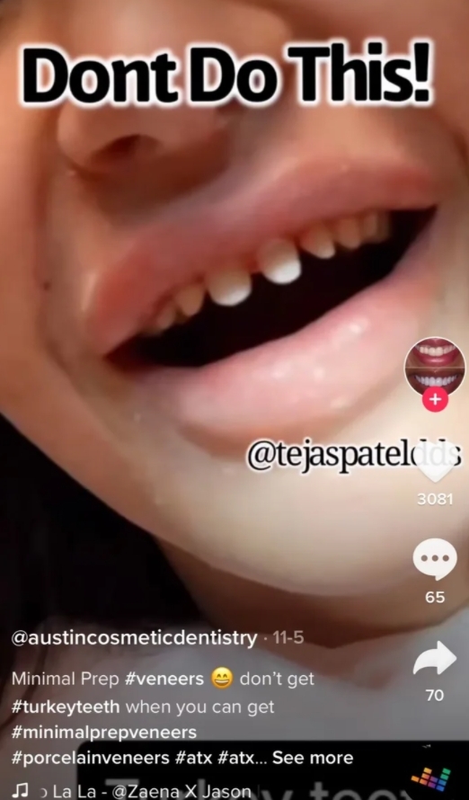 近日的抖音上就出現了一個＂Shark Teeth＂（鯊魚牙齒）新熱潮，