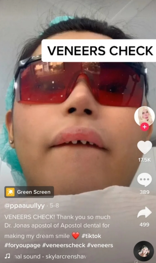 近日的抖音上就出現了一個＂Shark Teeth＂（鯊魚牙齒）新熱潮，