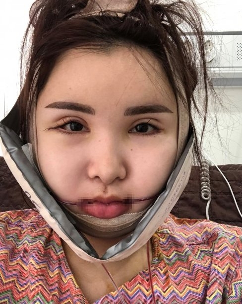 【整容後遺症】最後手術也成功了,同時也瘦了8公斤。家人了解她的狀況後,也每天發短訊關心和支持她,更貼心照顧她起居飲食,為她烹調流質食物