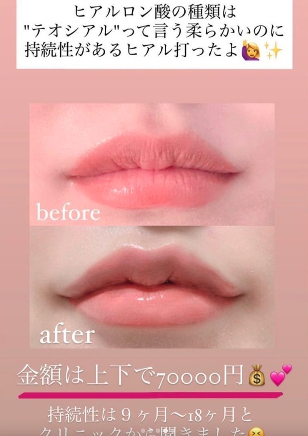 嘴唇也注入了填充物，讓嘴看起來嘟嘟的，翹起來會讓人感覺十分可愛。