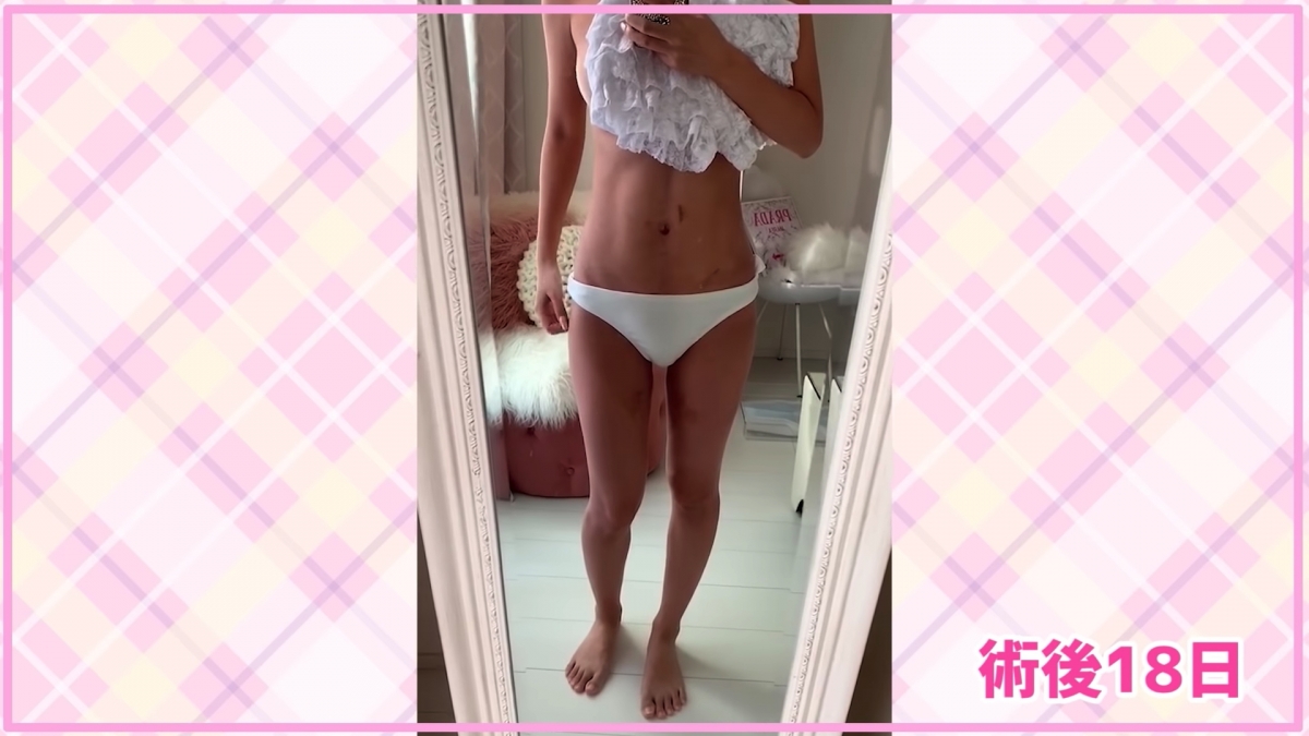 除了臉部的整容，她們也有進行身體抽脂，術後的身體佈滿瘀青，十分驚人。不過在術後的18日後，她就成功獲得了用錢就快速換來的腹肌線和完美的身段。