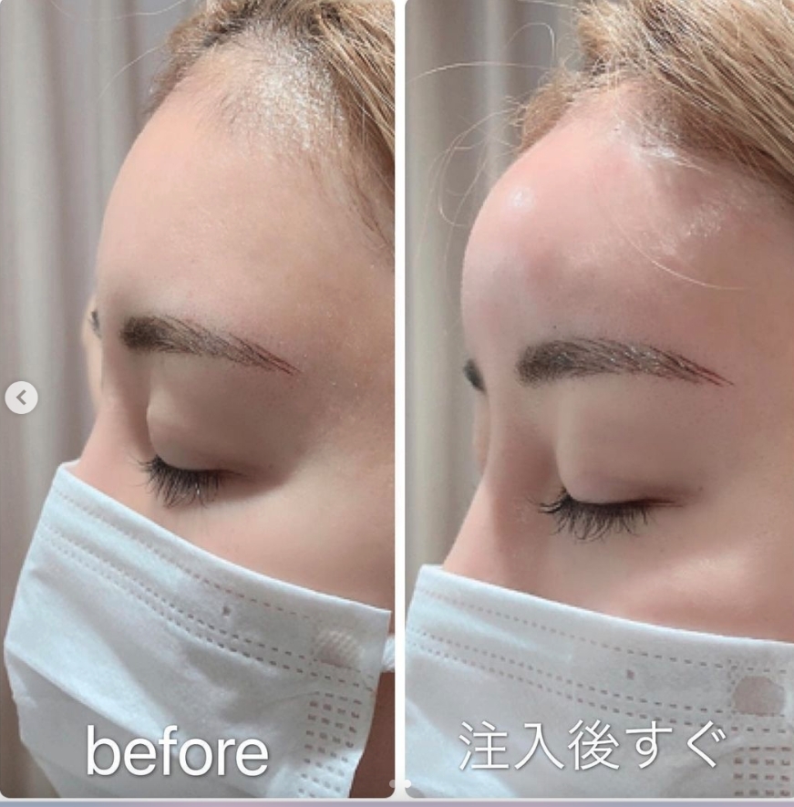 額頭的注射也讓臉型更立體，額頭的弧度加強了不少，不過不少網民也認為太誇張。