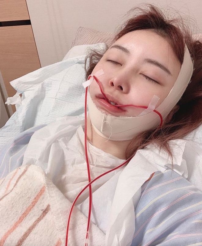 姐姐千惠在2個月前就有最新的一次削骨手術，改善面型輪廓。術後復康時，臉型也腫得像麵包，和妹妹合照時一點也不像。