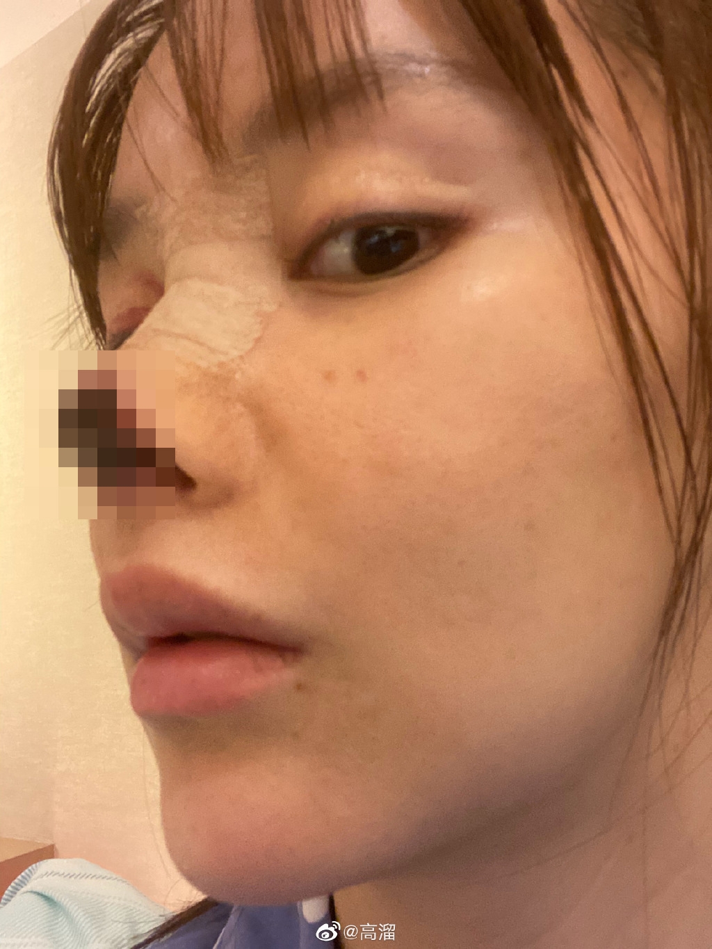 內地女星高溜就是其中一個例子,近日她更勇敢地跟大家分享自己整容失敗