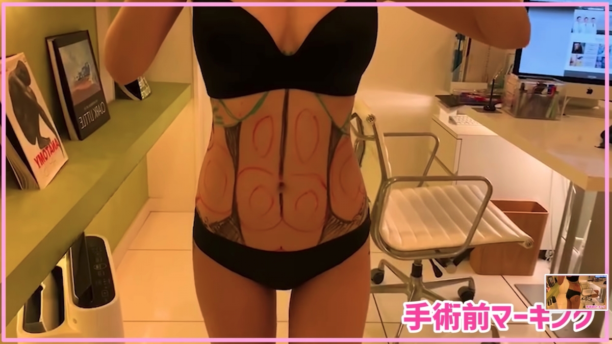 除了臉部的整容，她們也有進行身體抽脂，術後的身體佈滿瘀青，十分驚人。不過在術後的18日後，她就成功獲得了用錢就快速換來的腹肌線和完美的身段。