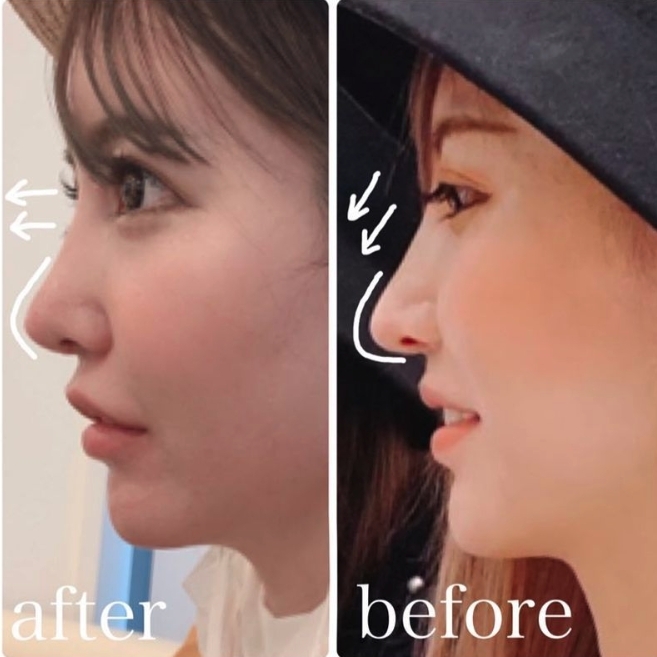 鼻子和臉型的改動最近比較頻密，不時都要「進廠維修」，她們也十分希望自己的鼻子又直又挺，容不下一點瑕疵。不過姐姐的鼻子已經硬得很難動了，在影片中看起來也十分不自然。