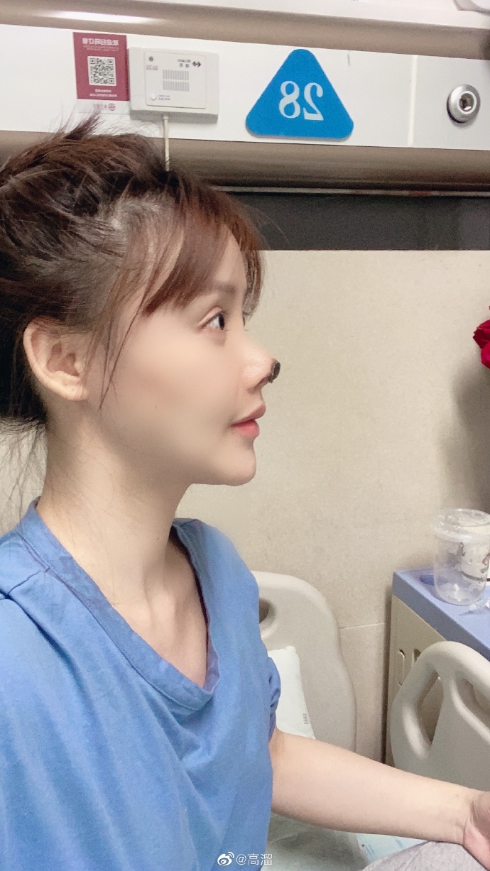 高溜鼻子整容手術失敗