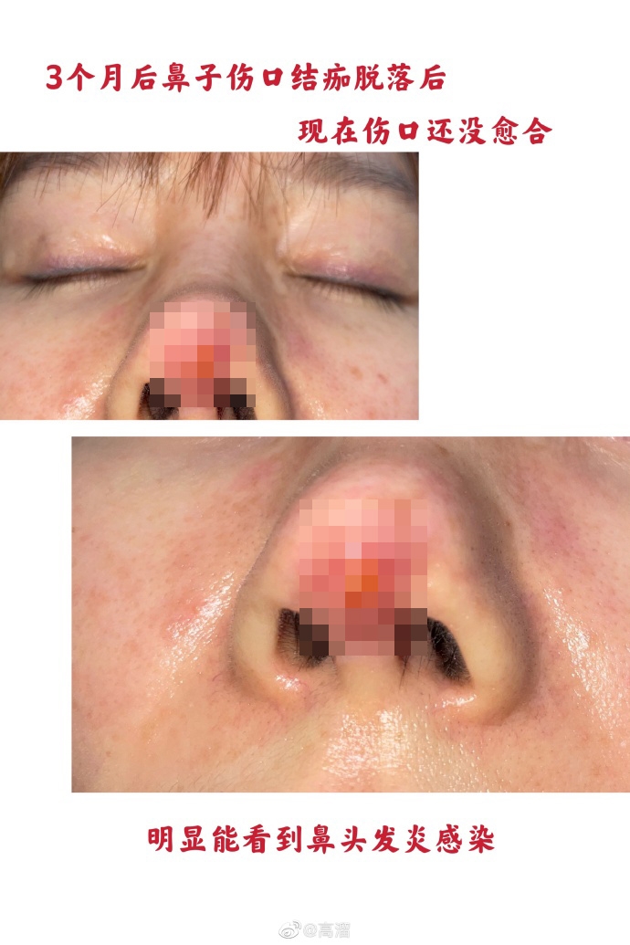 高溜鼻子整容手術失敗