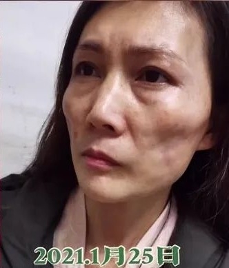 她發現這些情況不但沒有散去,臉部還逐漸變得消瘦,嚴重凹凸不平整張臉凹陷,輪廓尖銳如同女巫!