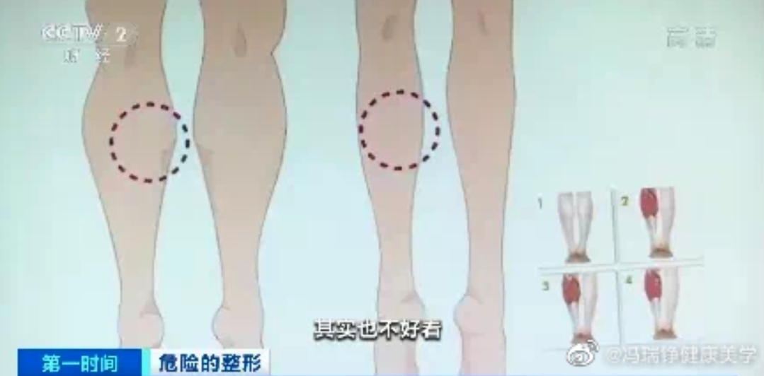 小腿肌肉阻斷,瘦小腿,蘿蔔腳,肌肉腿