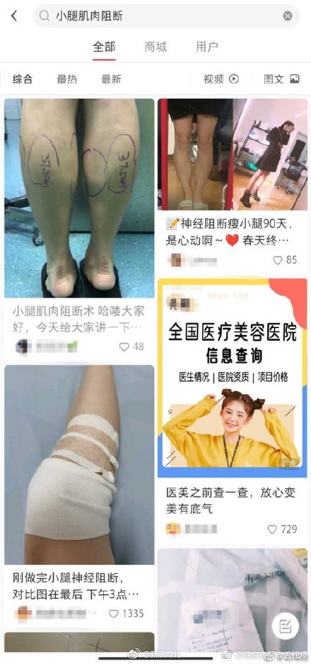 小腿肌肉阻斷,瘦小腿,蘿蔔腳,肌肉腿