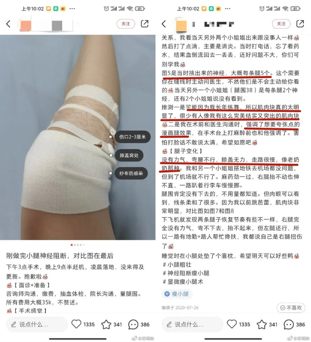 小腿肌肉阻斷,瘦小腿,蘿蔔腳,肌肉腿