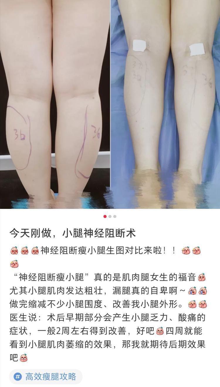 小腿肌肉阻斷,瘦小腿,蘿蔔腳,肌肉腿