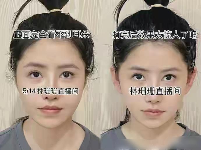 大陸整容新潮流「精靈耳」,KOL風靡打針改耳型變阿凡達?網民嘆:容貌焦虑連耳仔都唔放過