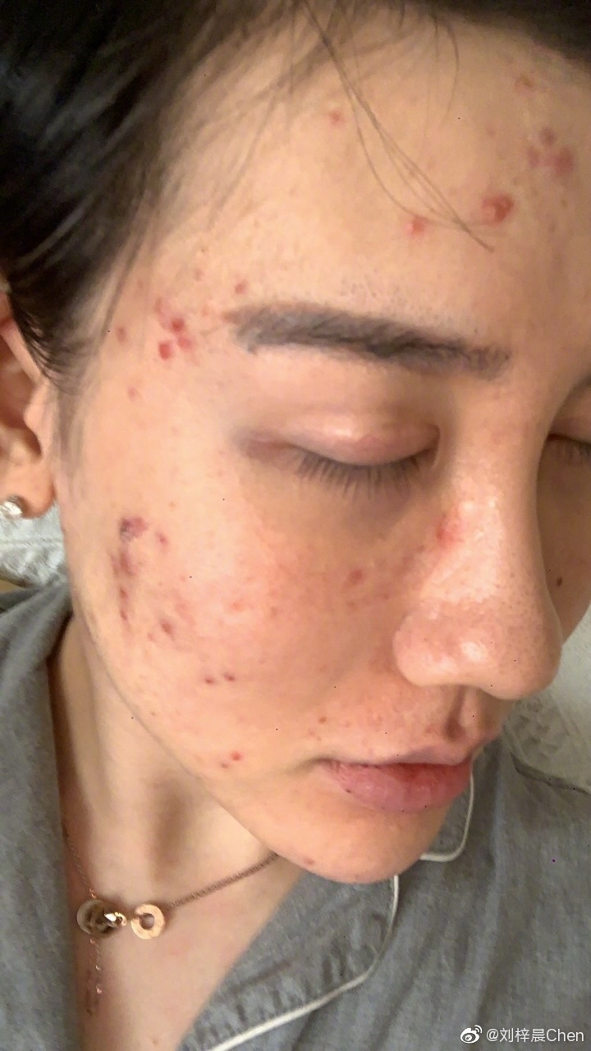 蛇精男劉梓晨亦有透露自己之所以臉上長滿痘痘,原因是他自己胡亂吃藥,導致內分泌失調