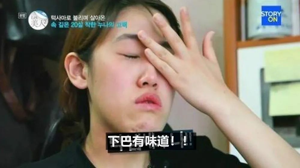 ViuTV造美人|許藝恩天生下顎過長,有超明顯的前突問題,這讓她在日常進食時也難以咀嚼食物