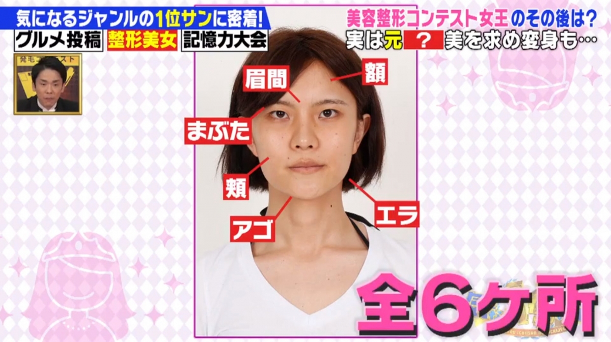 馬場汐音贏得比賽後，就在臉上6個部位動刀，包括眼皮、額頭、腮骨、眉骨和下巴。她的樣貌終於如她所願，變得毫無菱角