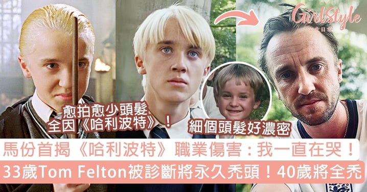 馬份揭《哈利波特》職業傷害累永久禿頭！33歲Tom Felton被診斷將全禿全因「一原因」？