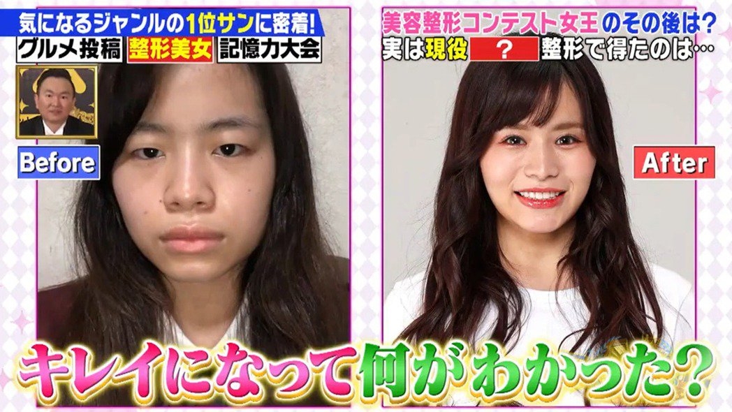 日本整容選美-整容後的「尾上七海」仿如變了另一個人似的，不但雙眼變大了
