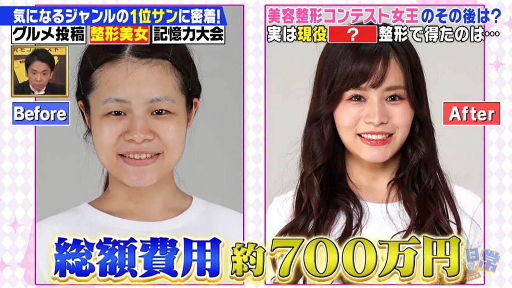 日本整容選美-整容後的「尾上七海」仿如變了另一個人似的,不但雙眼變大了