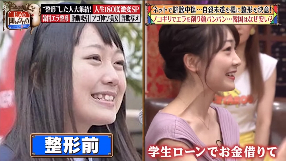 雛野まほ把牙齒調整好後就整顎骨。不過因為日本的整容手術費用昂貴，於是她就隻身飛到韓國削骨