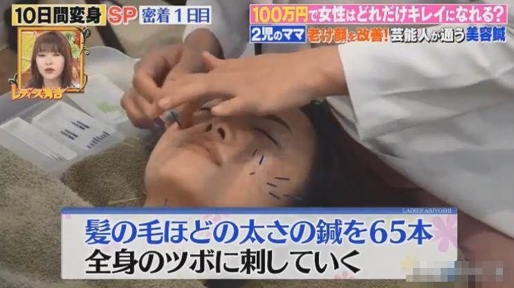 為了改善面色、色斑問題,她亦花大錢做激光打斑、針灸、種植睫毛、美白牙齒等療程,變靚決心超大啊!