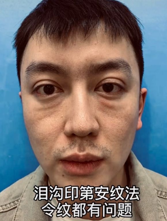 金大威在抖音影片中表示，2019年在朋友介紹下才到一間工作室整容填充脂肪