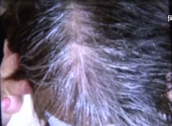 何女士卻發現自己生白頭髮的問題並沒有改善,反而頭髮卻越來越稀疏