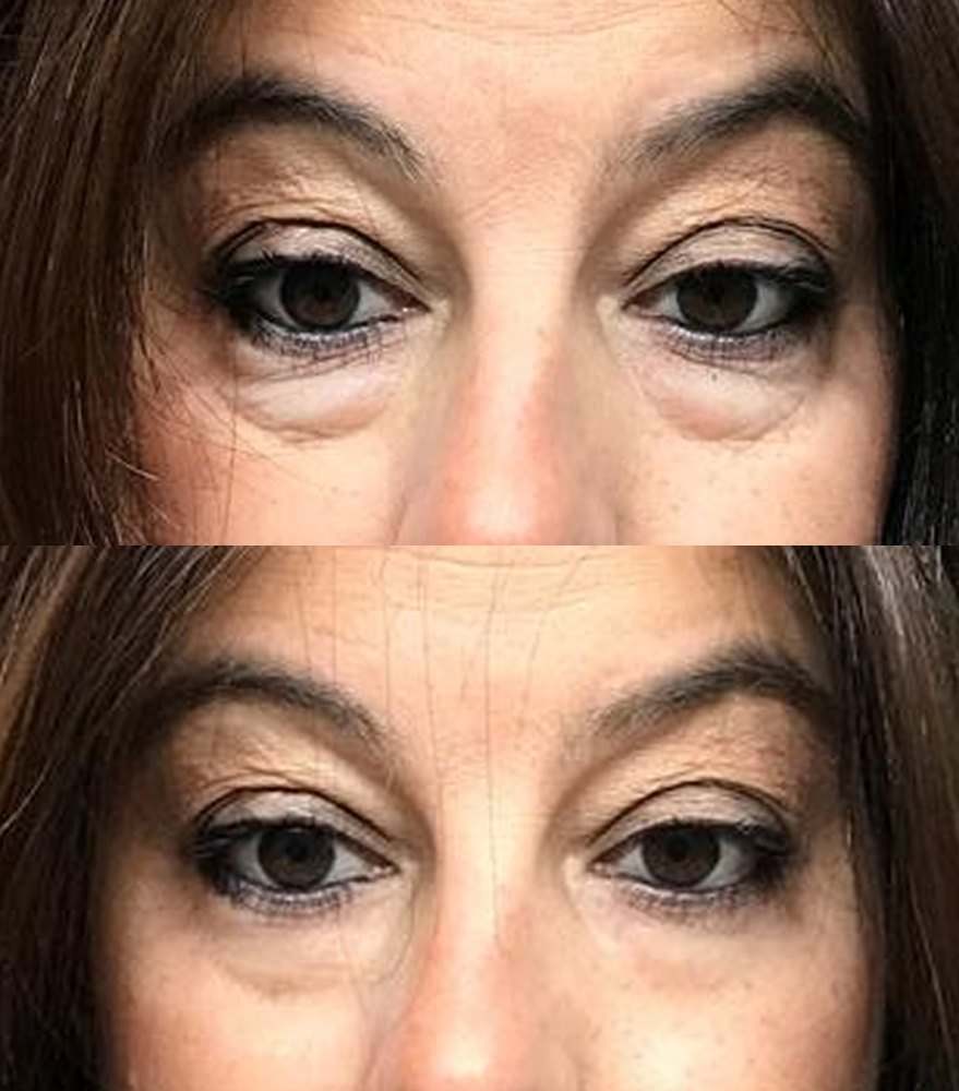 Peter Thomas Roth 官網亦有不少真實用家分享這款神奇眼霜的驚人效果,亦有不少用家給予高度的5星評價,大讚它即時緊緻眼袋、眼紋的效果的確十分出色