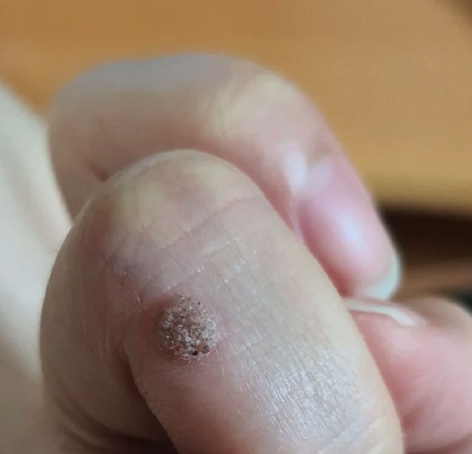 不過事件在搬走後還沒有完結,她事後知道老爺和叔仔其後在腳板上長了一顆顆像是「毒疣」的物體,其後才發現原來姑仔在兩年前就已經開始有「一顆顆」長在手上