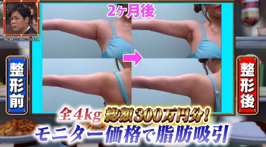 MiRichan聽說只要做過抽脂，身體便會變成「不易胖體質」