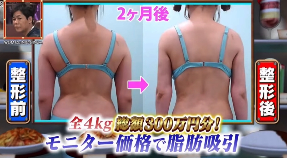 MiRichan 表示之所以想抽脂，是因為知道自己的性格無法堅持減肥