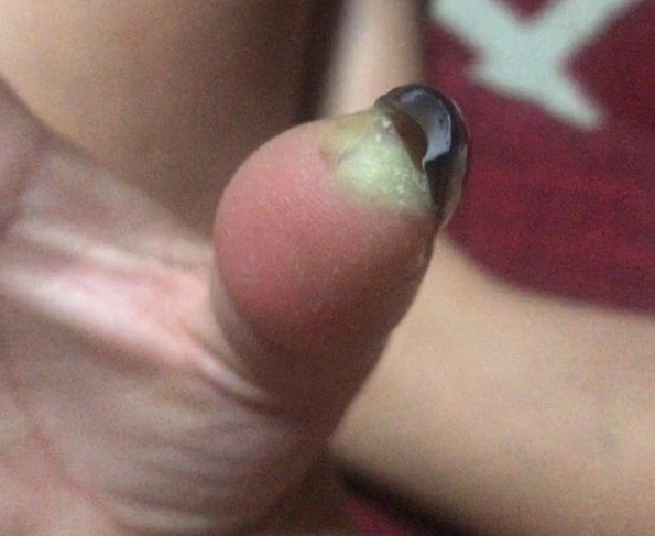 醫生為Jenneffer處方消炎藥、抗生素等藥物,讓她回家再作觀察!