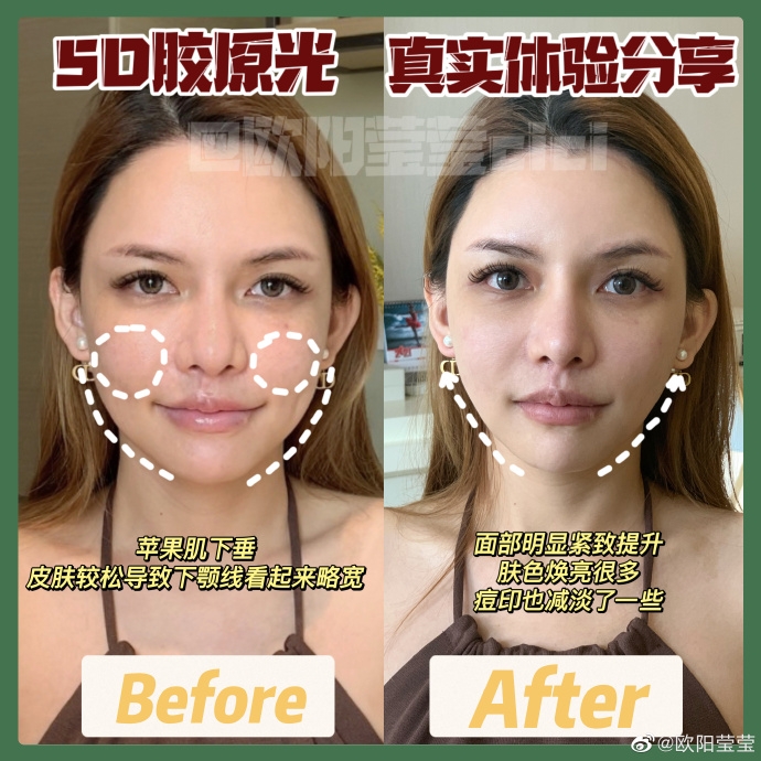 她把每次醫美經歷寫成日記,拍下手術前後對比圖向網民分享,至今已在醫美平台累積超過500篇日記