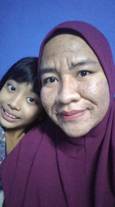 諾艾在懷第二胎時疑受到因懷孕而引起的激素影響,臉上竟長滿皺紋,外貌變到跟老婆婆沒有分別