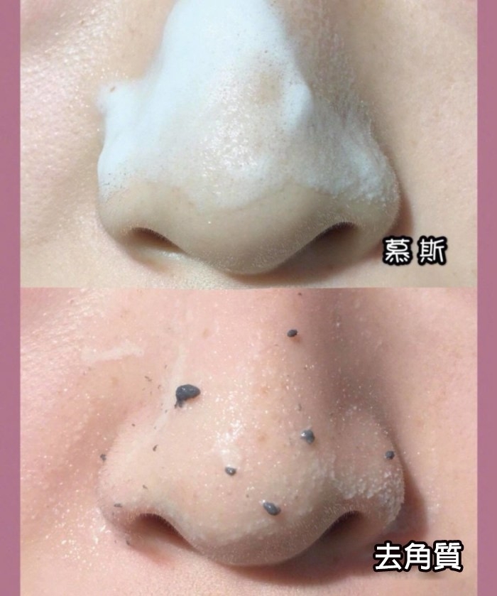 厚敷凡士林後,黑頭就浮上面,所以很易就能抹去黑頭