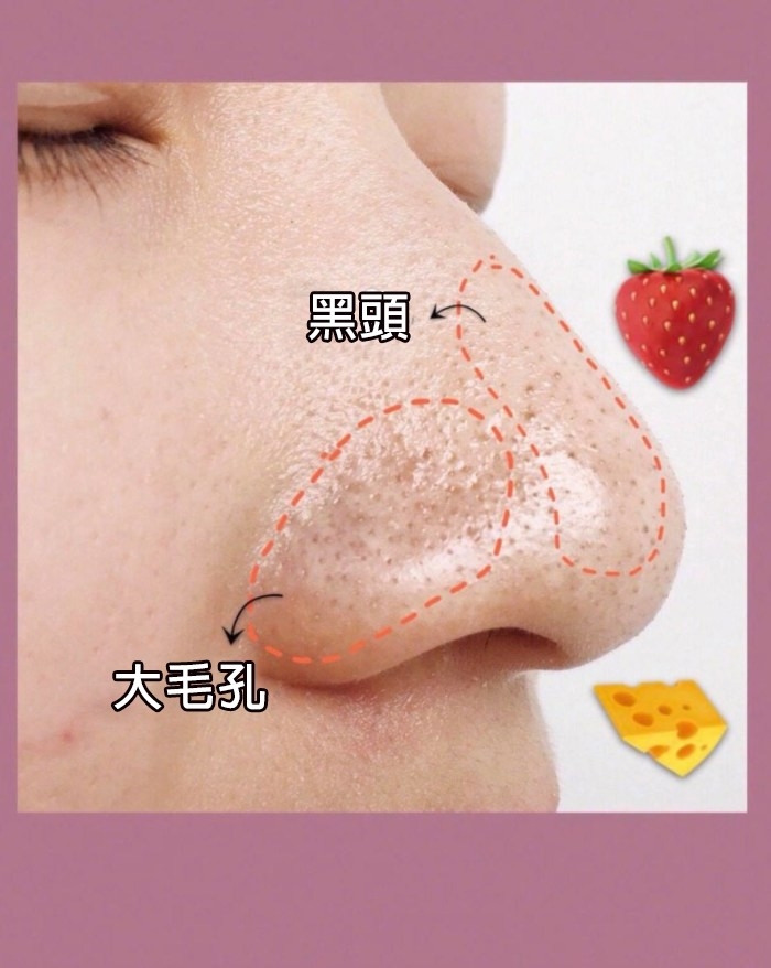 想清黑頭可達致最佳效果,首先要用溫熱毛巾敷在鼻子約 5 分鐘