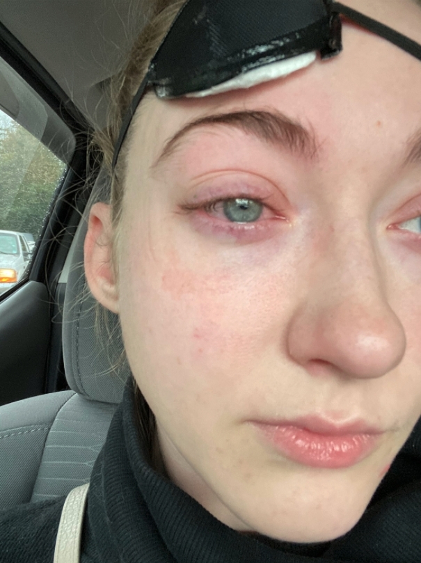當Jordyn打算除下右眼的隱形眼鏡時,她形容隱形眼鏡有種「卡住」的感覺!