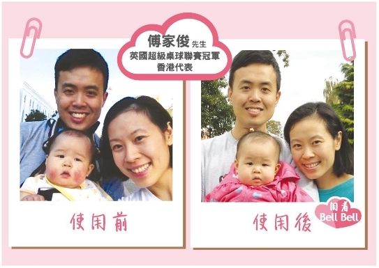 傅家俊的女兒Bell Bell臉上有濕疹時也是使用這枝乳霜來紓緩、止痕~