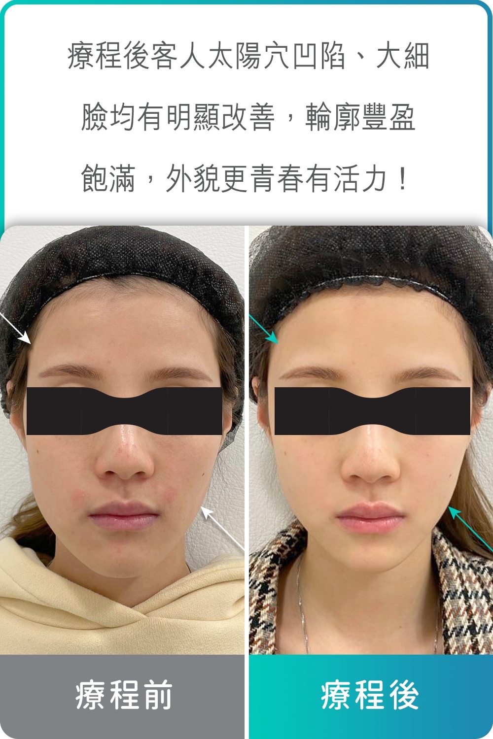 療程前後客人面部輪廓分別
