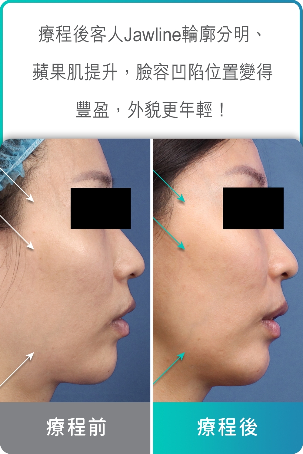 療程前後客人Jawline分別