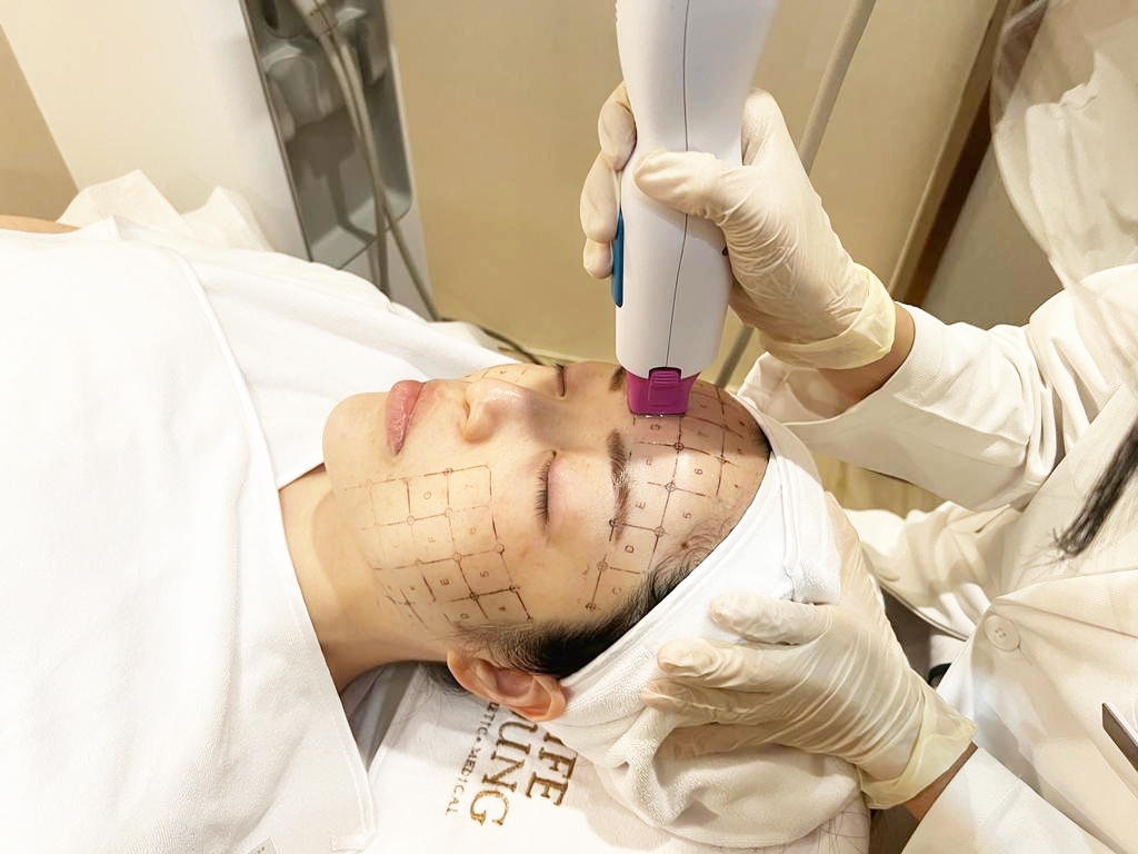 6月必試體驗價$11,800/600發(原價$39,000)「最新5代Thermage FLX射頻緊膚療程」