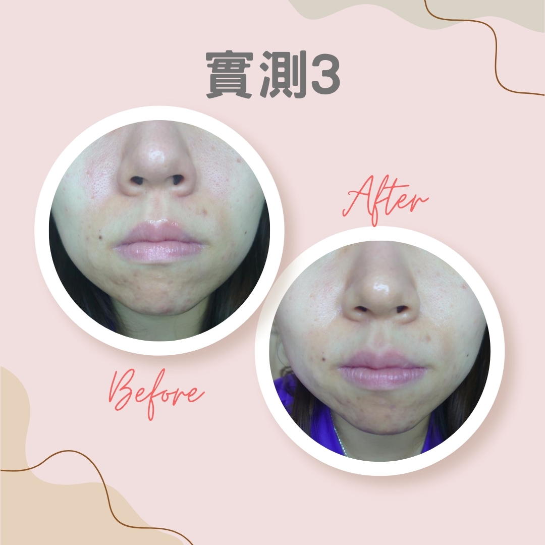 實測3：有效鎮靜皮膚