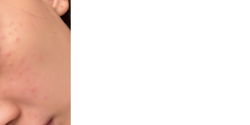 Santis表示由細到大都好少生粒粒及敏感，前陣子受口罩肌困擾，不斷生粒粒