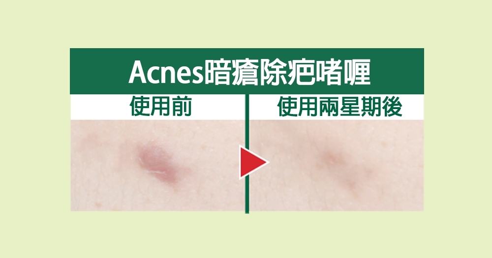 Mentholatum Acnes