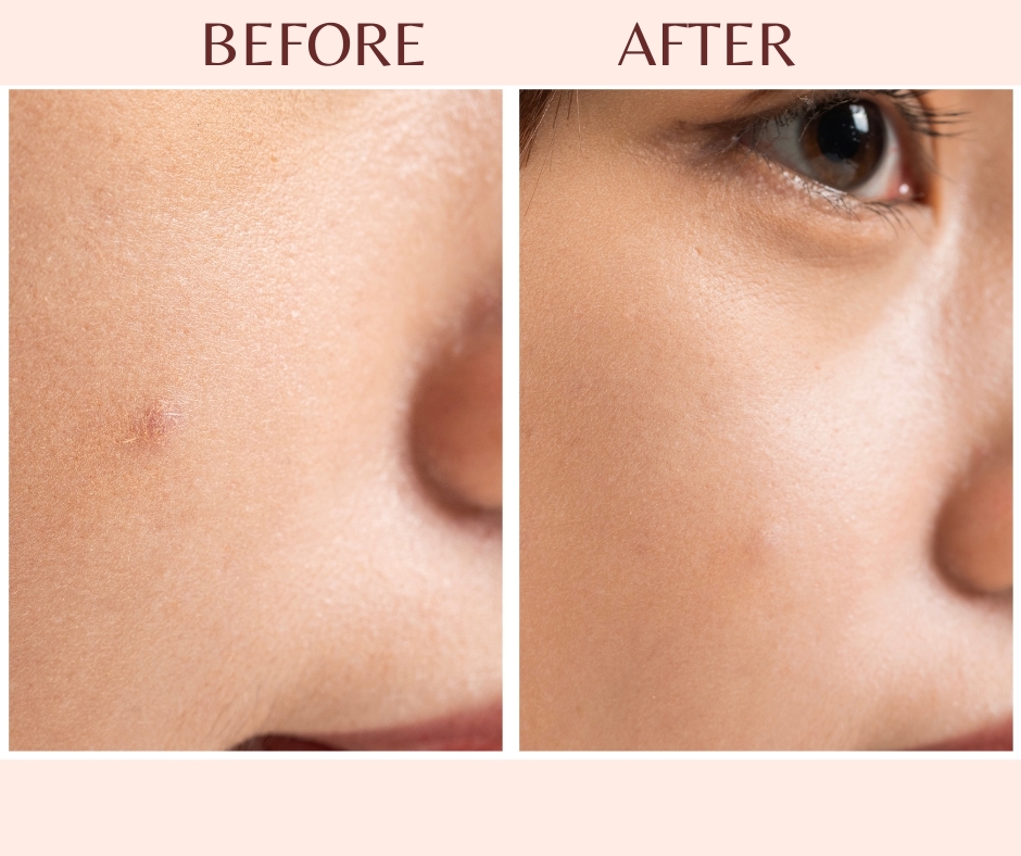 Joey更高呼使用短短一星期,原本連粉底都遮不住的暗瘡都變淡了~