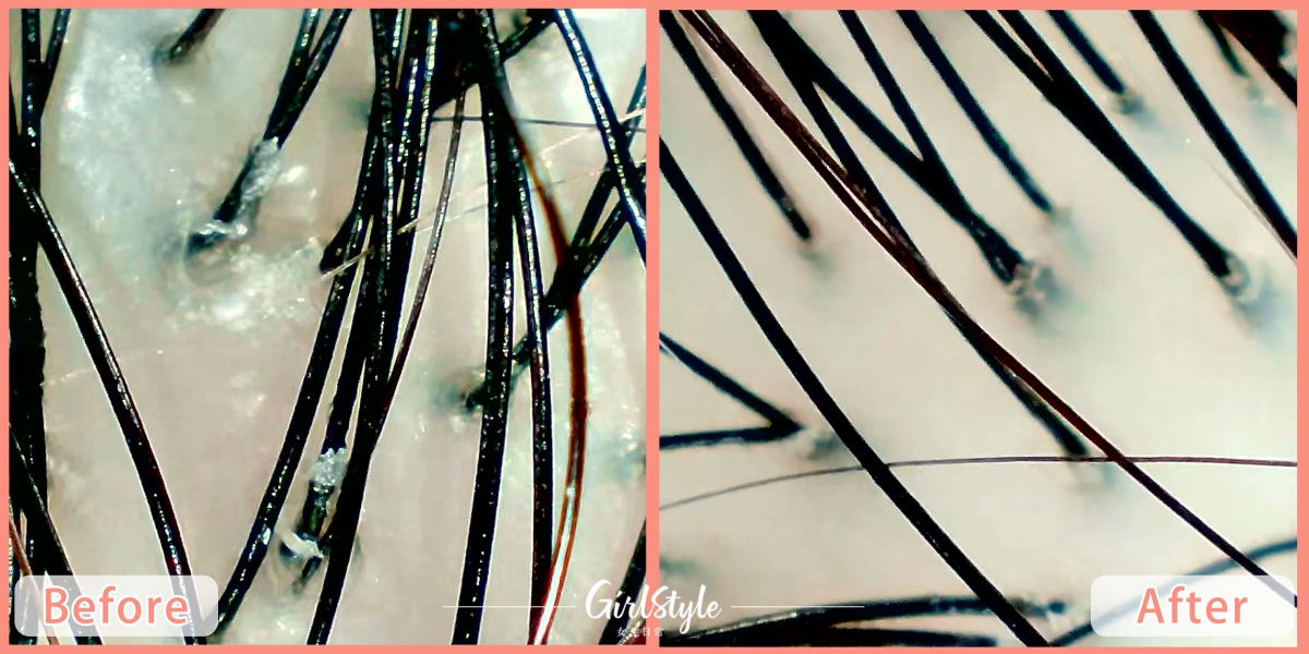 使用前(左):大片頭皮屑明顯剝落,頭皮少許發紅;使用後(右):頭皮屑問題不再,敏感問題舒緩