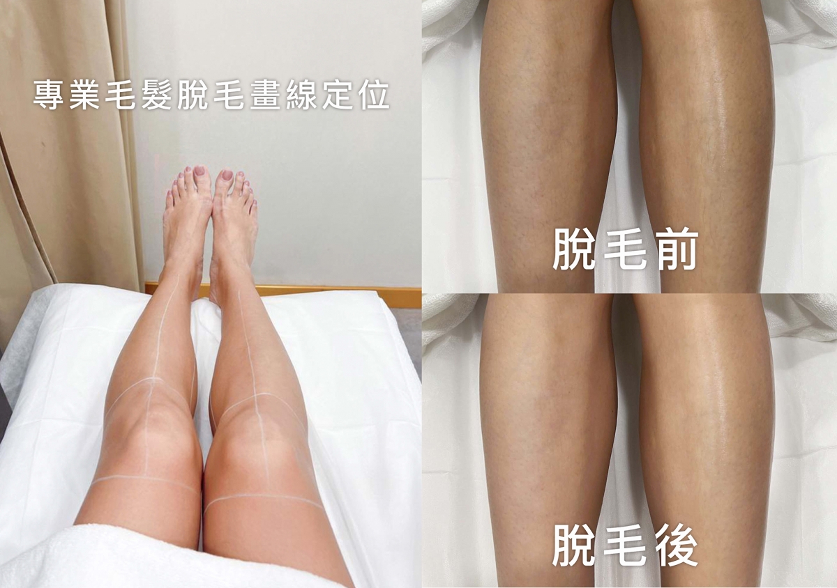 HAiRLESS治療師精準和安全地對準脫毛位置,帶來不一樣的激光脫毛推薦體驗。